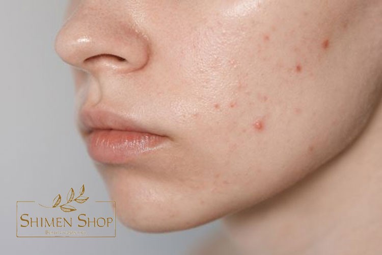 کرم ضد جوش چیست و چگونه عمل می‌کند؟